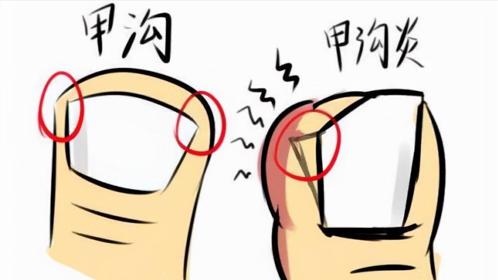 指甲往肉里长怎么办,指甲老往肉里钻