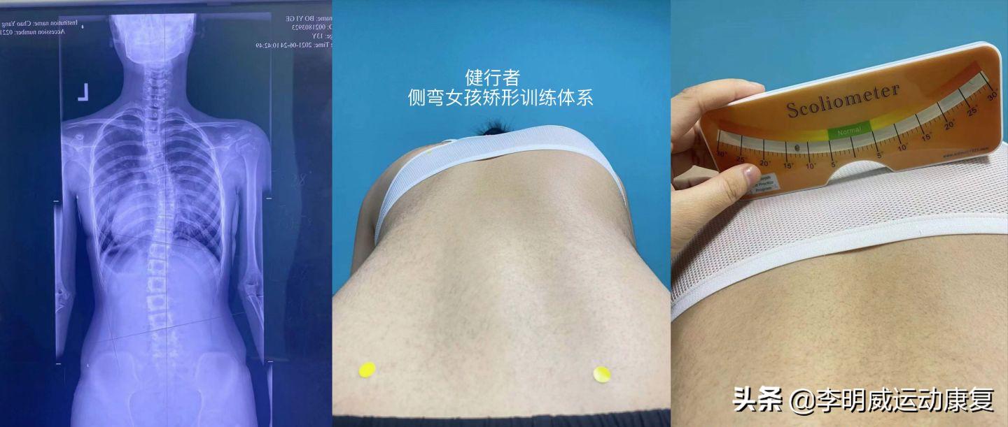 14岁脊柱向左侧弯13度要怎么矫正,14岁脊柱侧弯40度不治疗会加重呀