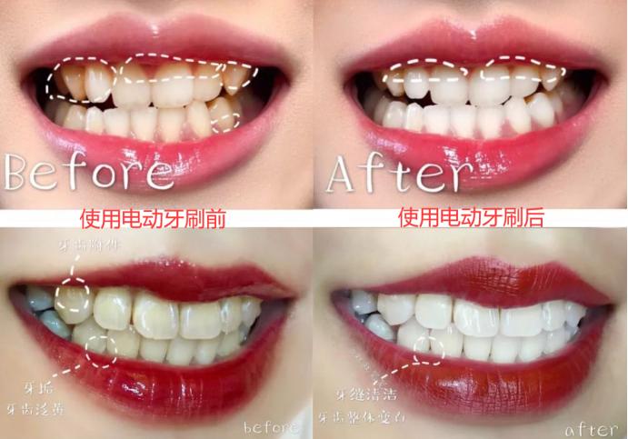 做过根管治疗还能矫正牙齿吗,根管治疗电动牙刷