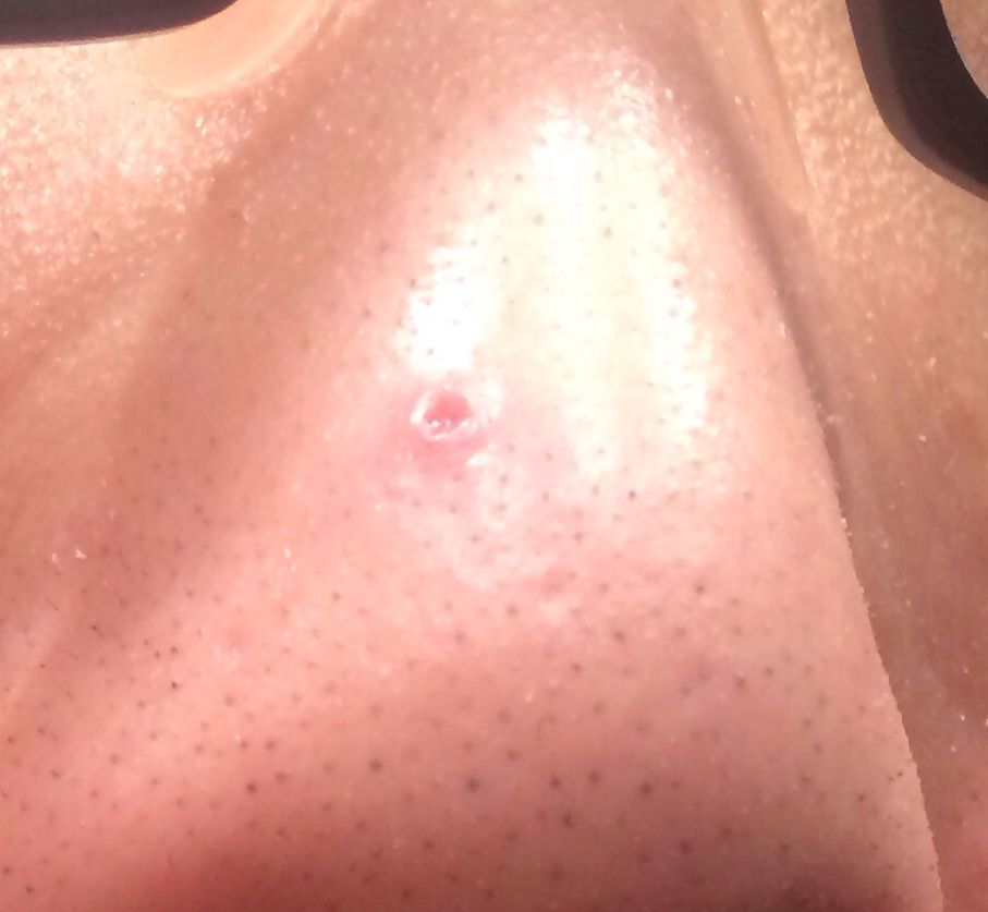 鼻子黑头挤出水一样的液体,鼻子挤黑头粉刺