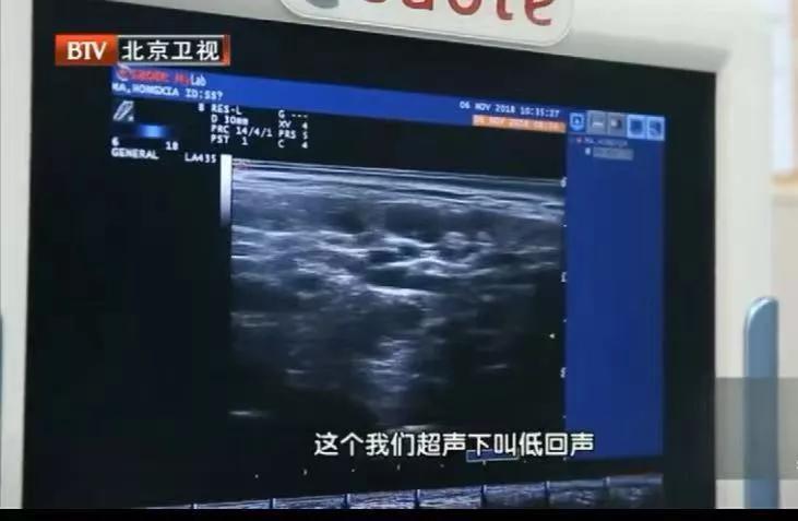 2年没复查结节竟然变成了癌症,息肉化验是癌前病变怎么办