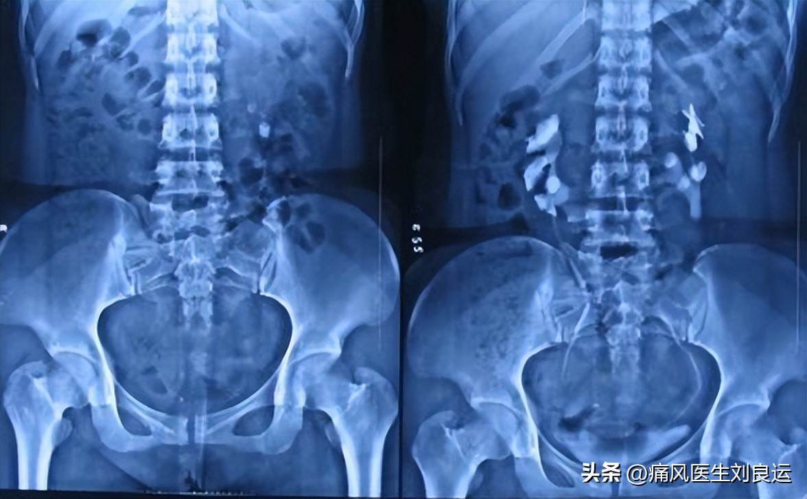 急性痛风吃秋水仙碱配什么,痛风吃秋水仙碱和非布司他的方法