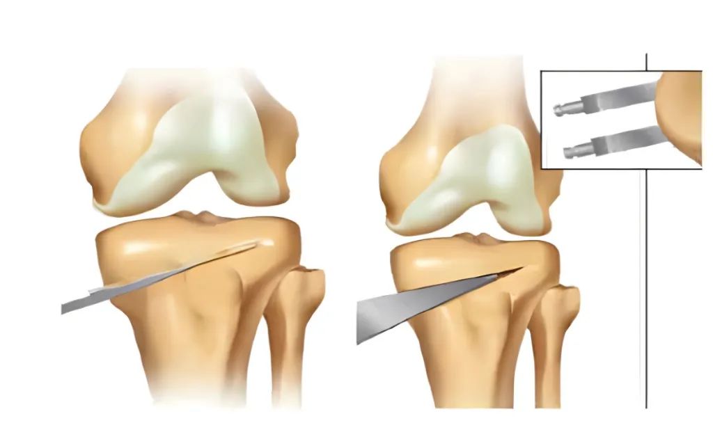 膝骨关节炎最快自愈方法,膝骨关节炎会导致哪些疾病