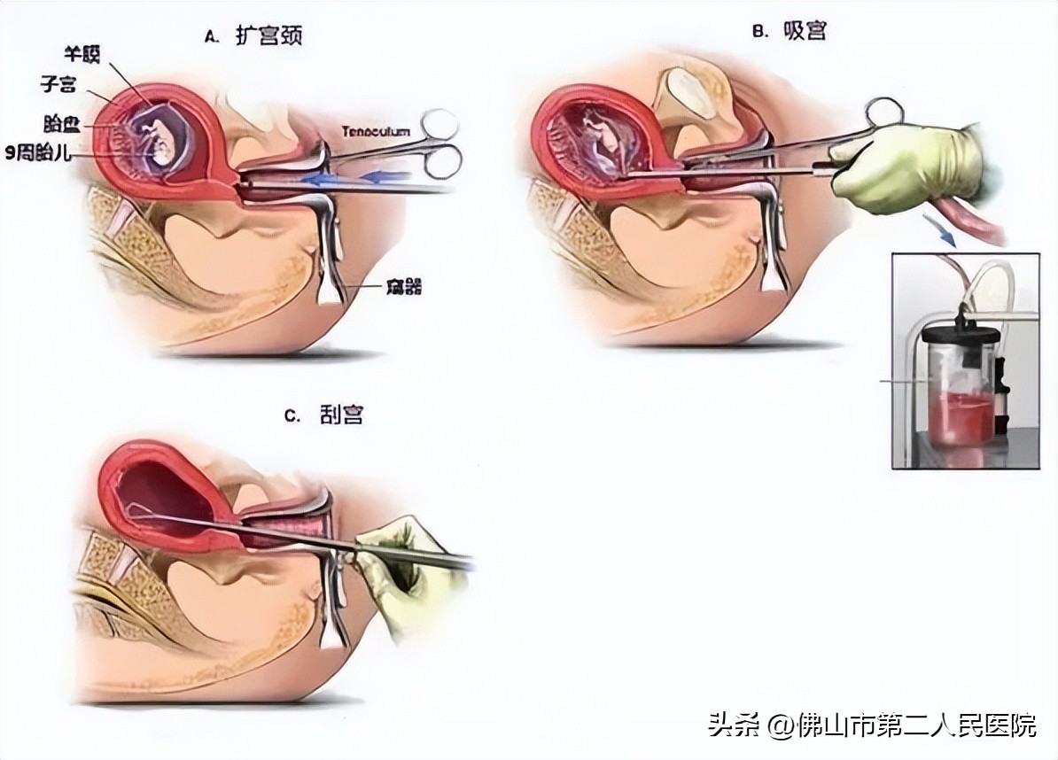人工流产当天去当天就能做吗,今天做人流明天去上班