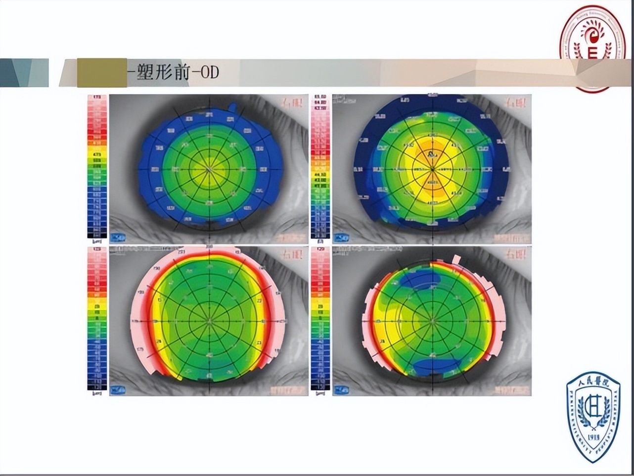 王凯角膜塑形镜原理,王凯医生塑形镜