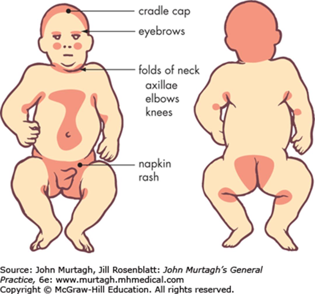 什么是湿疹湿疹是如何产生的,湿疹是什么原因造成的湿疹怎么治