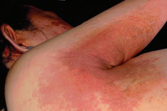 药物反应引起皮肤瘙痒,吃药后皮肤出现药疹