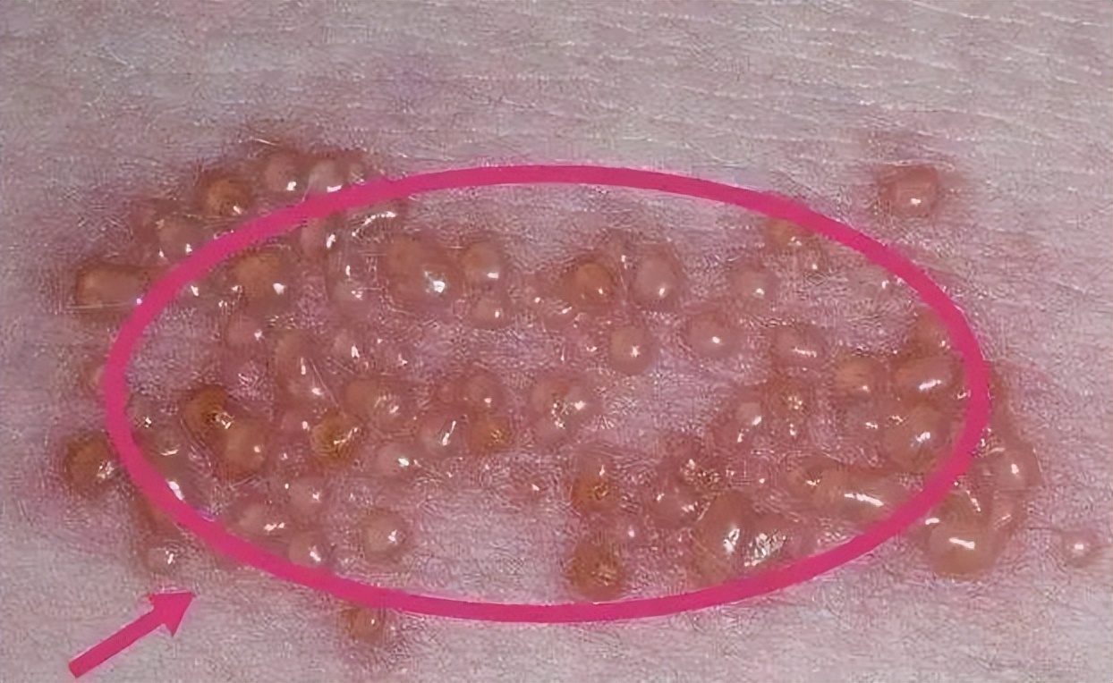 带状疱疹剧痛中医治疗,有一种剧痛叫带状疱疹