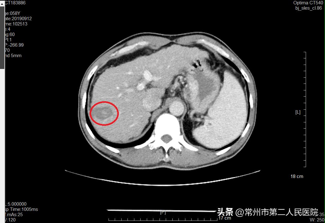 冷冻消融微创手术治肿瘤,精准微创治疗肿瘤