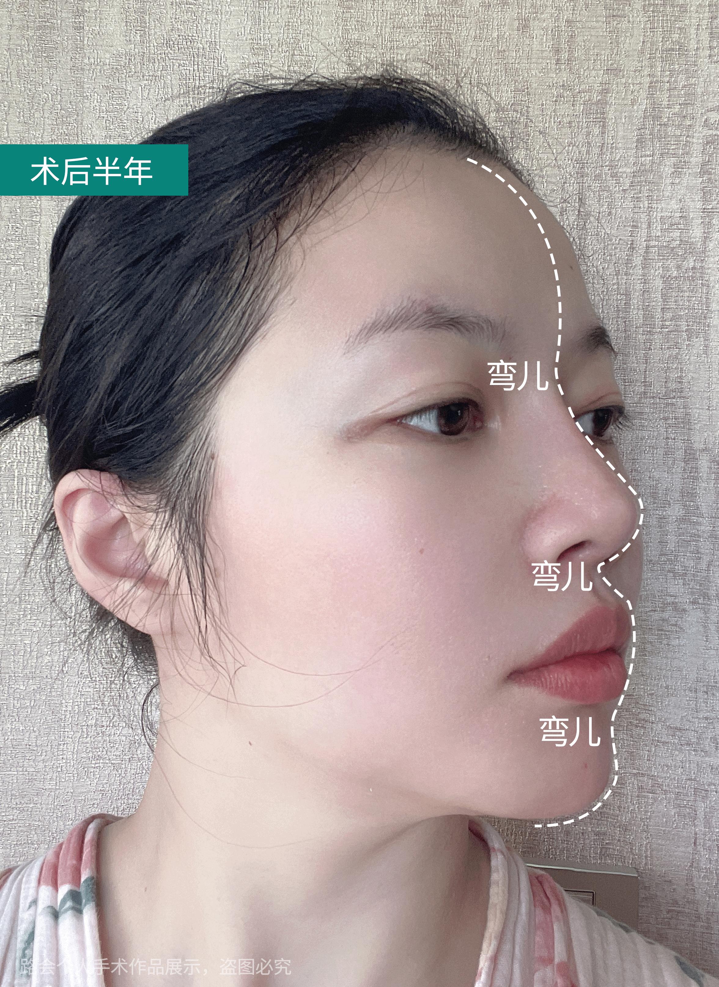 隆鼻失败鼻头有个坑的原因,隆鼻失败导致的鼻头凹陷怎么修复