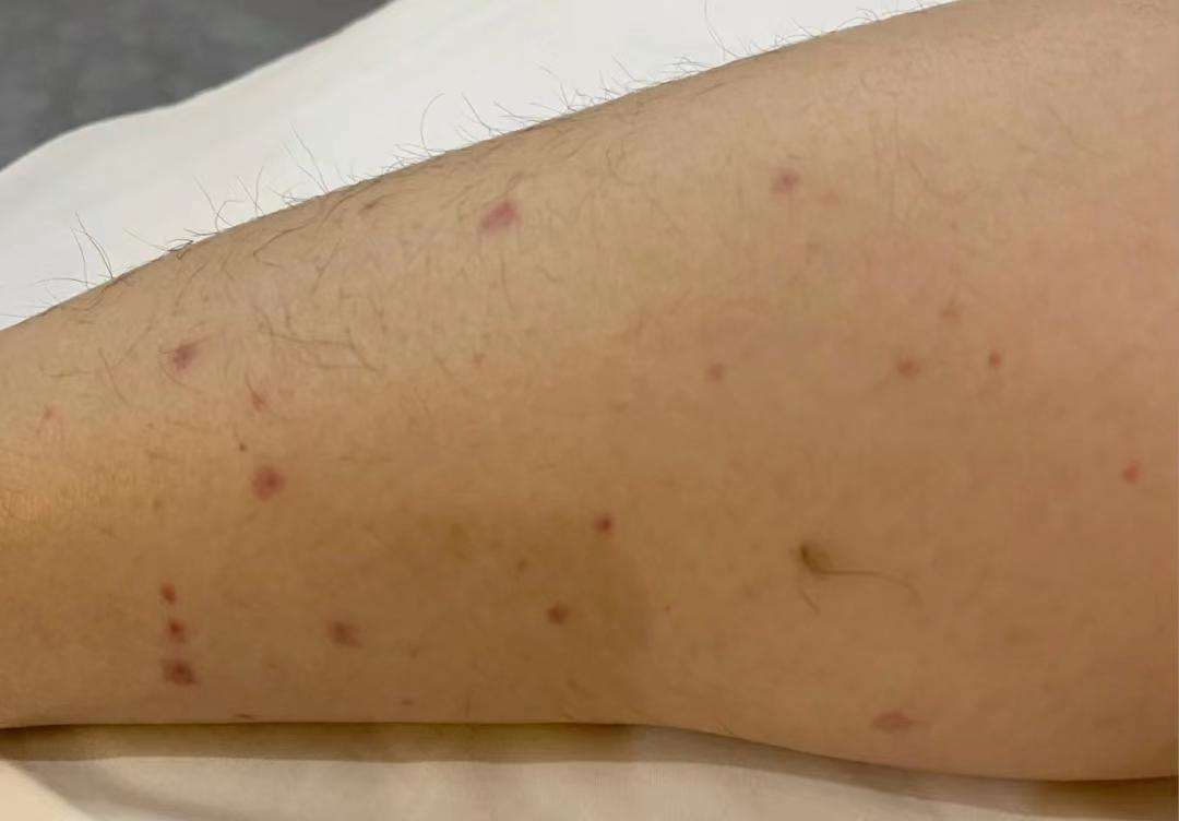 皮疹能完全治愈吗,皮疹可以治愈或者根治吗