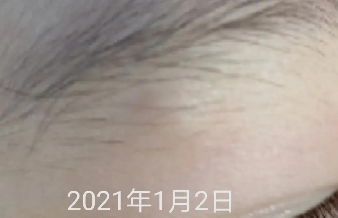 皮脂腺囊肿和粉刺瘤,火针治疗皮脂腺囊肿