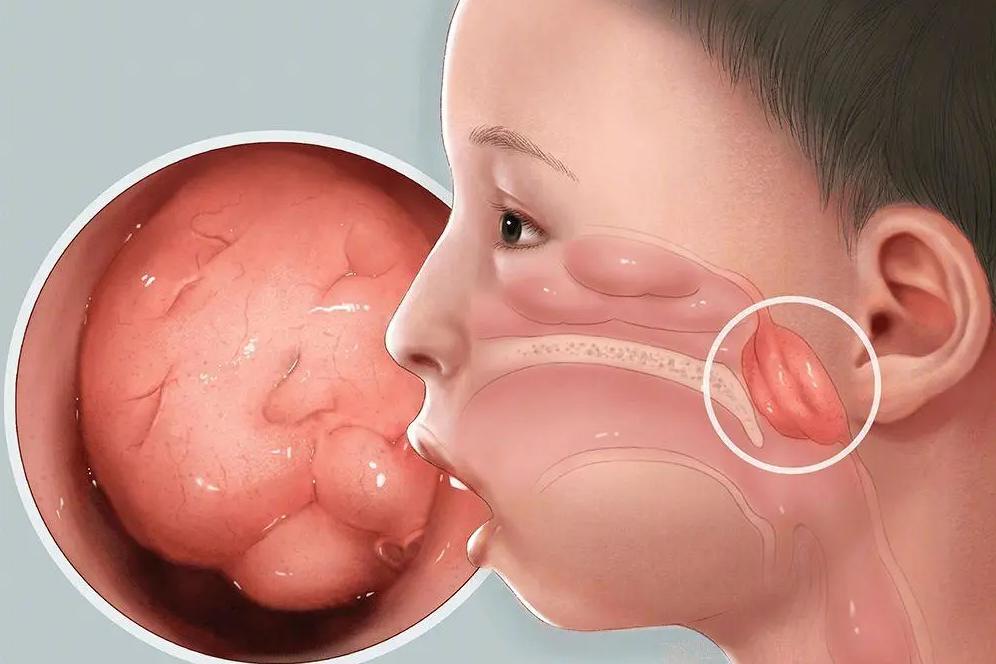 4岁女孩腺样体肥大不做手术，自拟银黄双解汤，腺样体明显回缩！