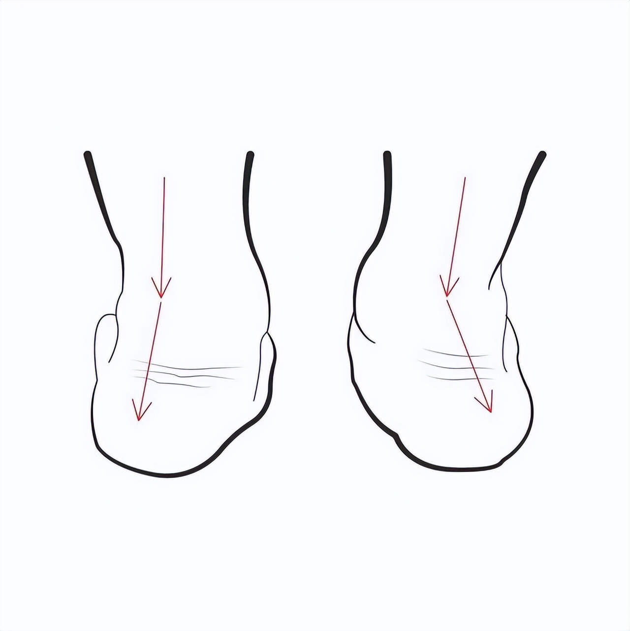 滑雪摔到髋骨韧带损伤,滑雪伤到踝关节