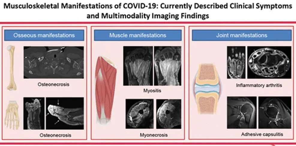 新冠哪些关节会痛得厉害,新冠的关节痛是怎样的