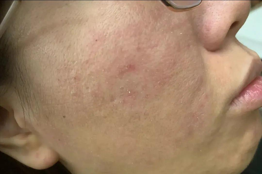 面部皮炎是炎症吗,脂溢性皮炎面部痒