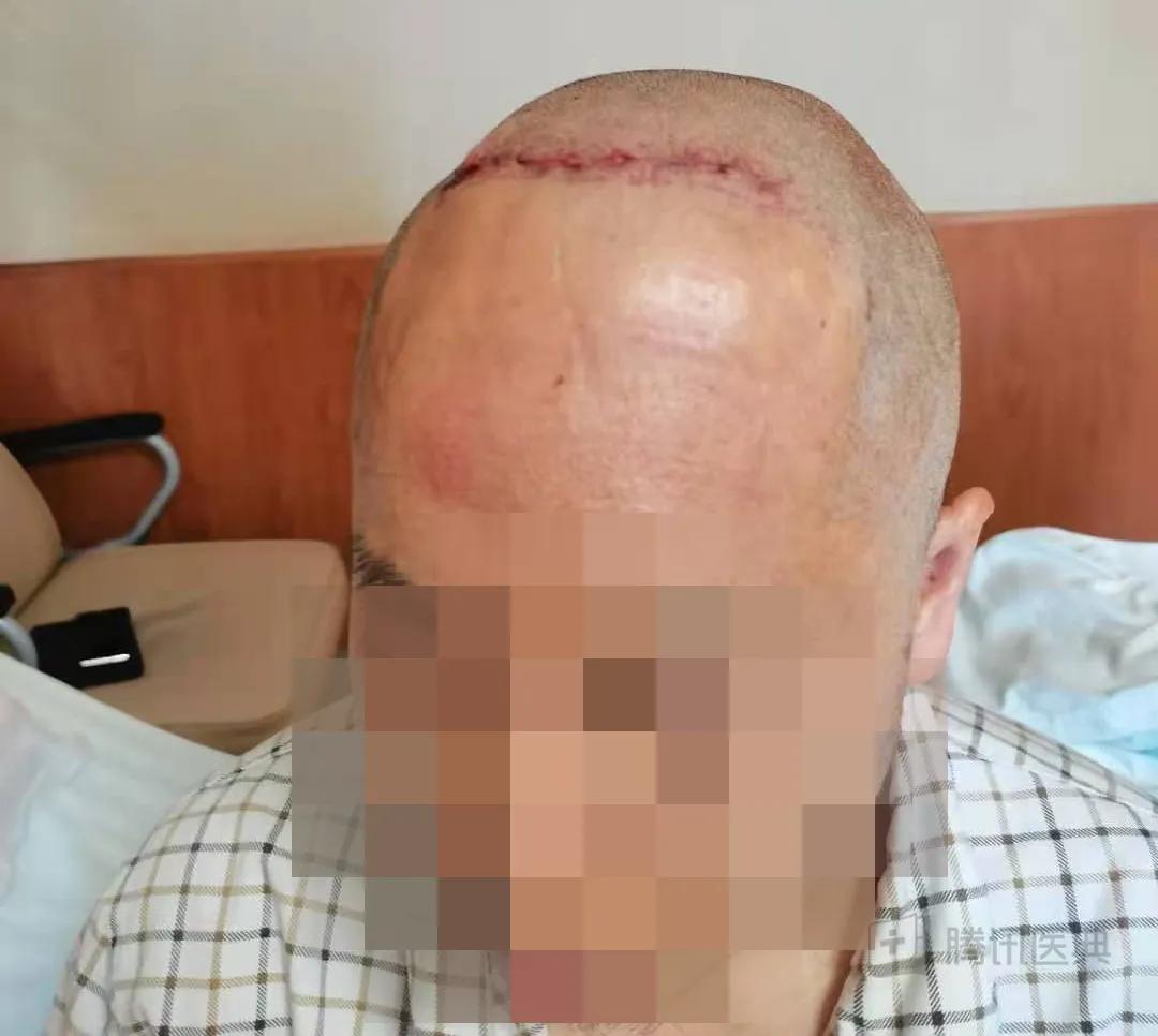 开颅手术后被掀开的头皮多久恢复,开颅手术掀开头皮头皮怎么恢复的