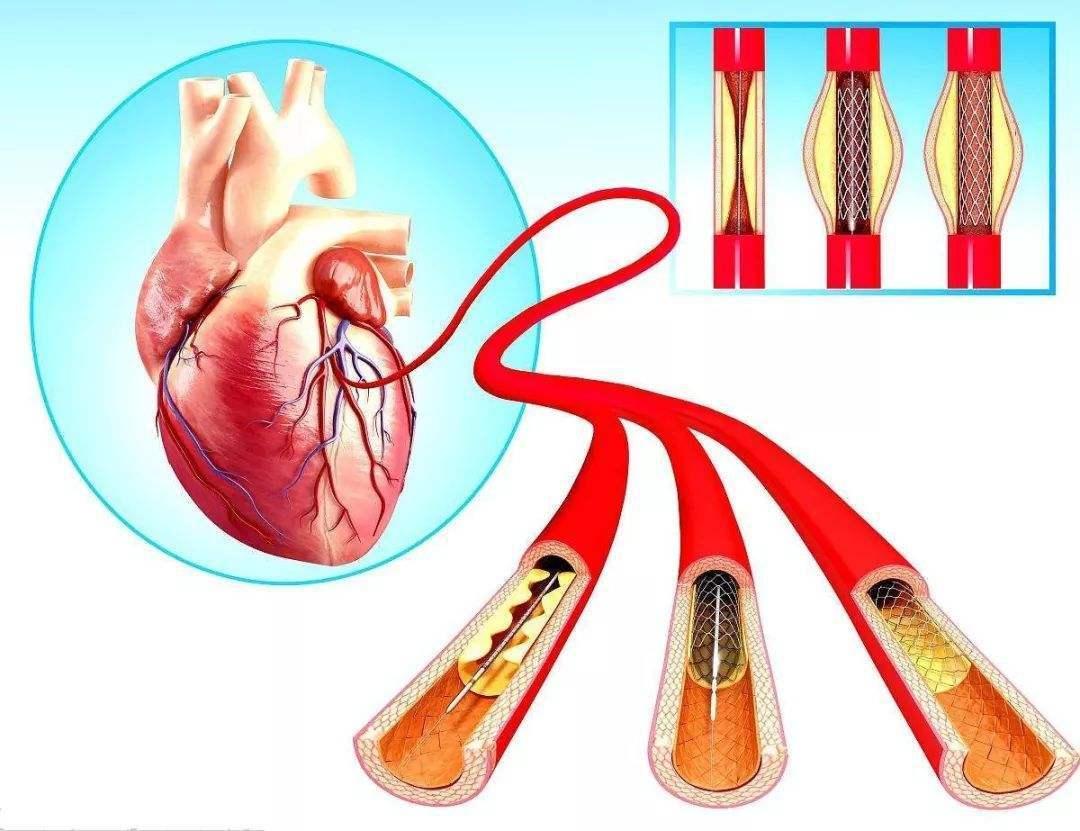 700块的心脏支架和20000块的药物球囊，哪个更好？医生：别误解了