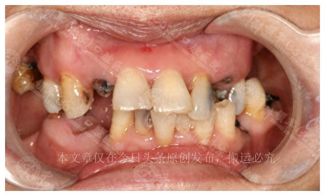 女儿做种植牙手术,老年人做全口种植牙