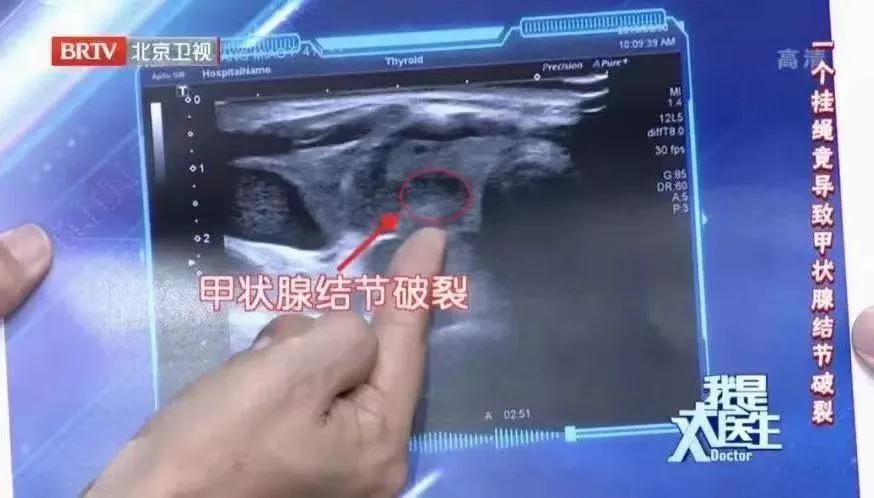 2年没复查结节竟然变成了癌症,息肉化验是癌前病变怎么办