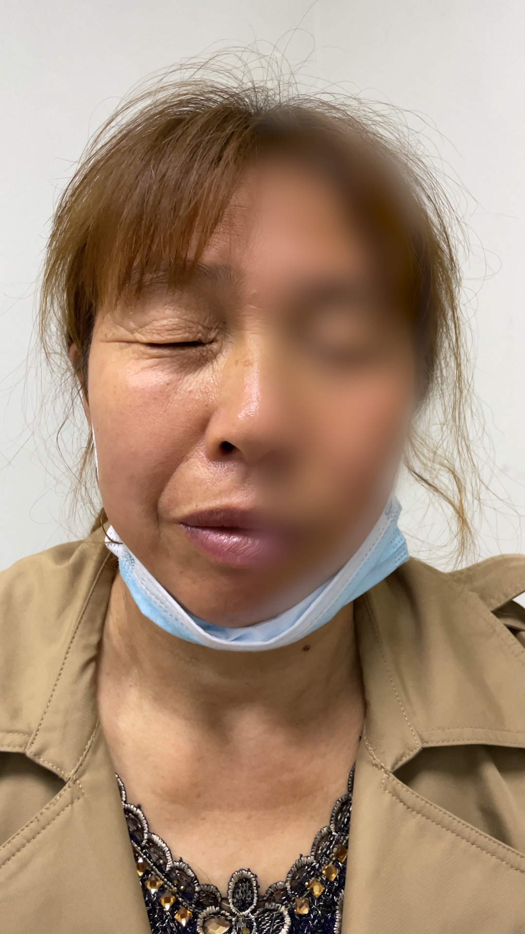 眼皮经常乱跳警惕面肌痉挛找上门,左眼皮上眼皮一直跳面部痉挛