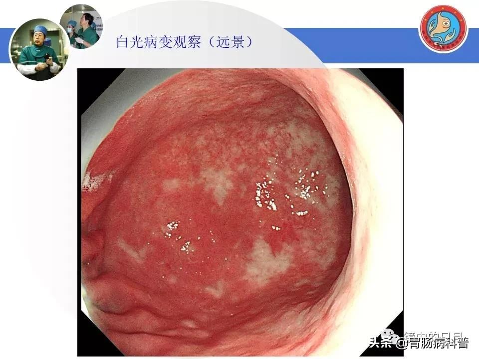 胃癌可以做内镜手术吗,早期胃癌内镜手术后追加外科手术