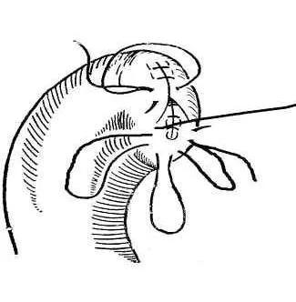 医考知识点总结：十二指肠残端破裂。