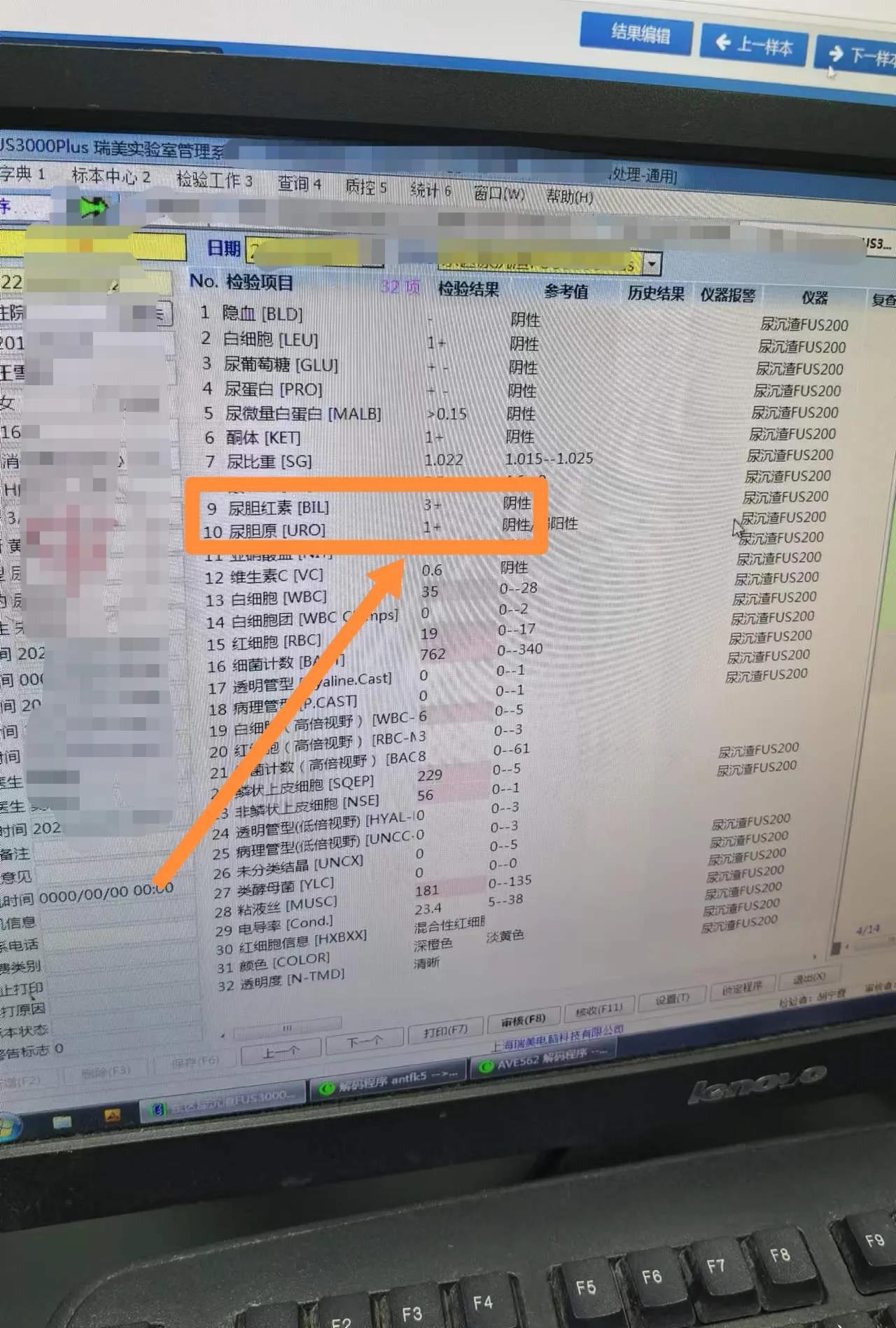 上火会导致尿液发黄吗,小便发黄是体内有火吗