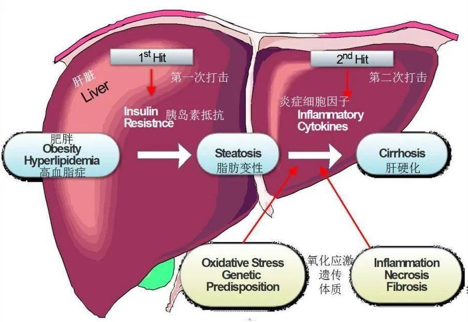 非酒精性脂肪肝的治疗,酒精性脂肪性肝病