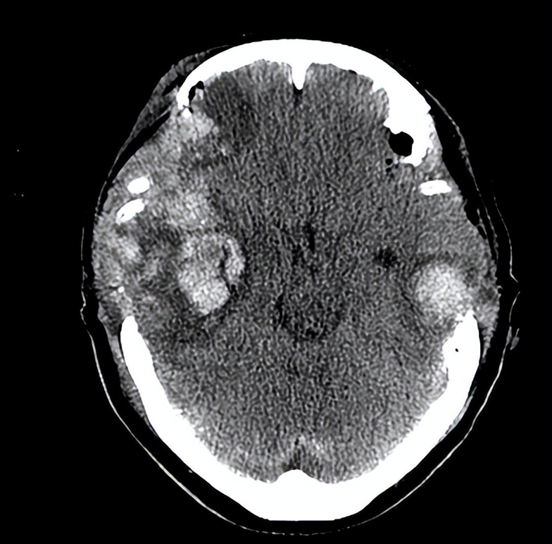 医院成功救治重型颅脑患者,特重型颅脑损伤治愈案