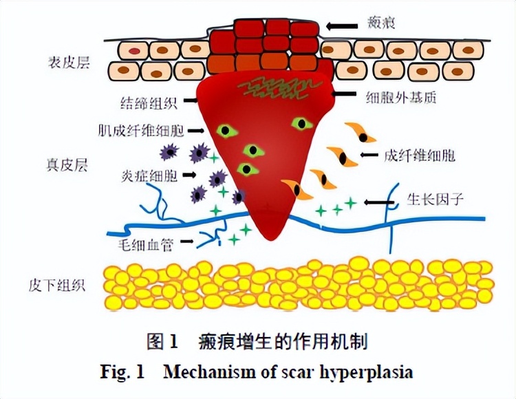 研究出阻止纤维化的药物,瘢痕疙瘩研究进展