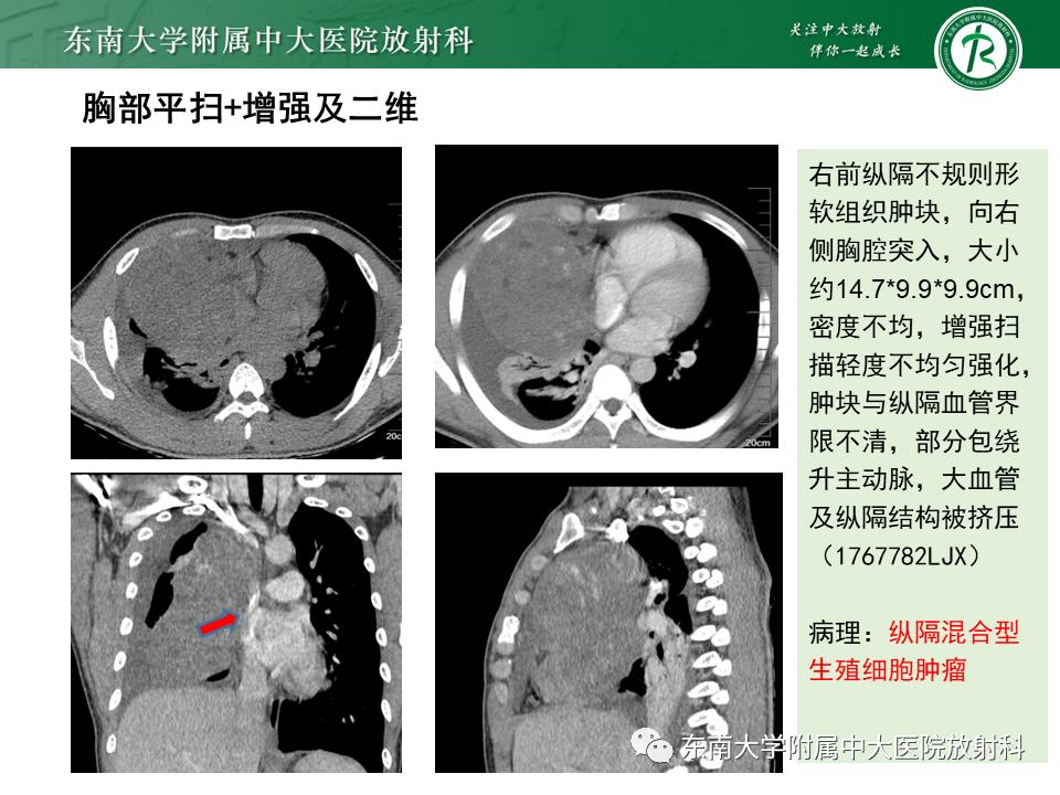 好文分享值得深思,纵隔精原细胞瘤
