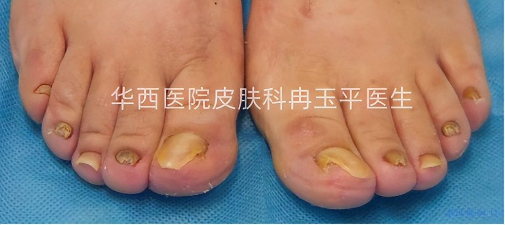 灰指甲到底算什么病,指甲黄是不是灰指甲