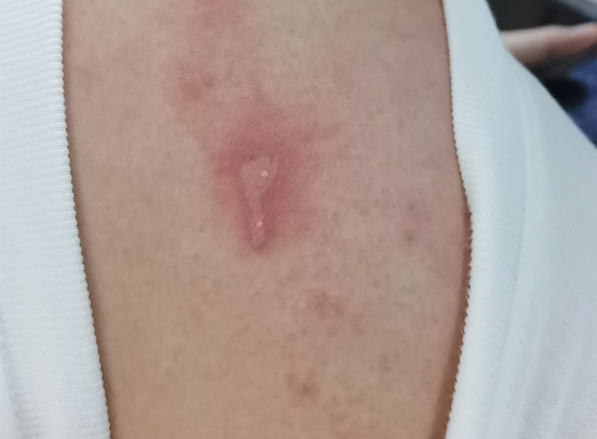 隐翅虫室内防范措施,当心隐翅虫