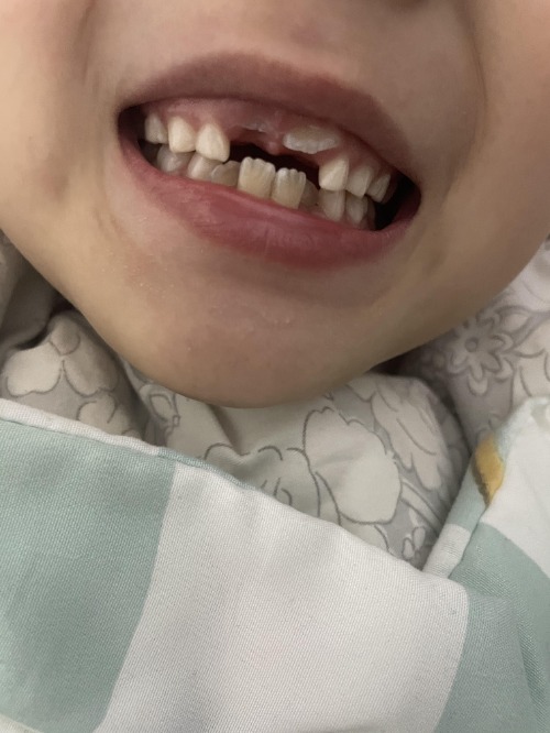 小叶医探,儿童长的恒牙是锯齿状的