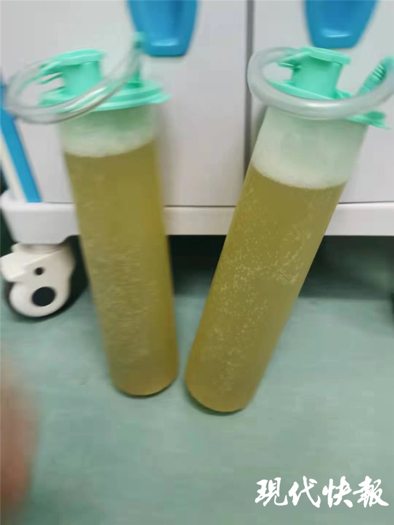 24岁女孩腹部增大取出16斤肿瘤,大妈体内竟取出上百肌瘤