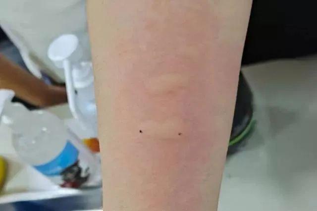 单侧鼻塞要警惕三种病,出现鼻塞的征兆怎么预防