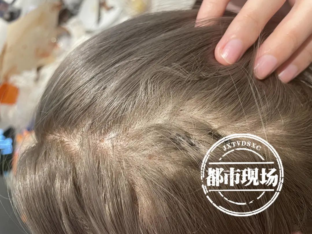 女子染发致坏死,南昌染发出血