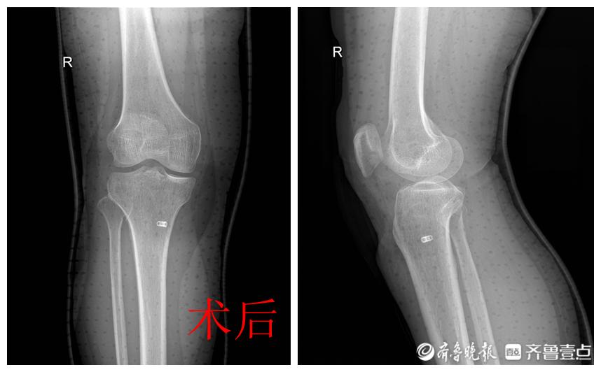 关节镜微创手术二级医院可以做吗,西医治疗粉碎性骨折