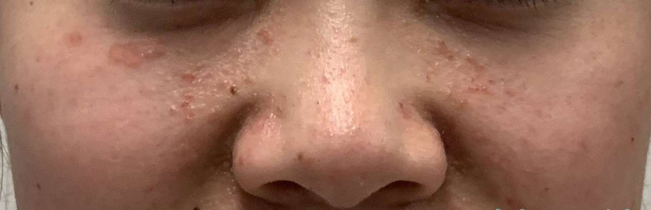 结节性硬化协和医院,协和医生说皮肤病