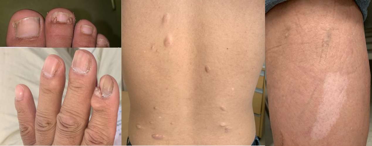 结节性硬化协和医院,协和医生说皮肤病