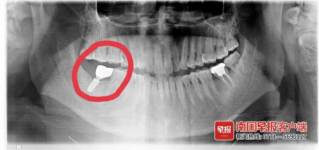 南宁一男子种牙断裂、螺丝残留牙床内！涉事医院回应