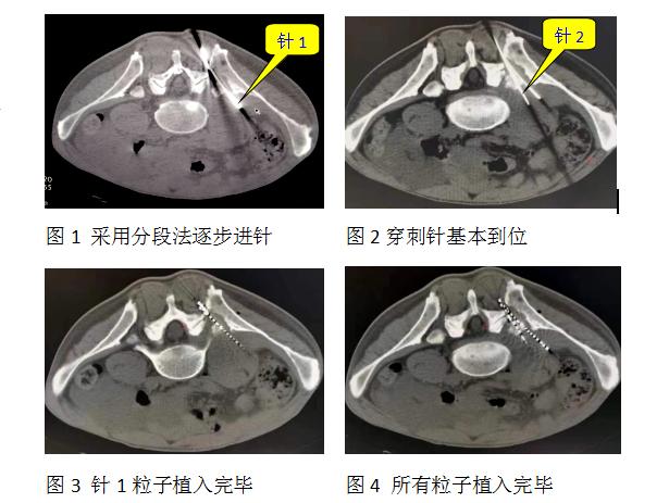 阳光融和肿瘤科怎么样,阳光融和医院放疗科