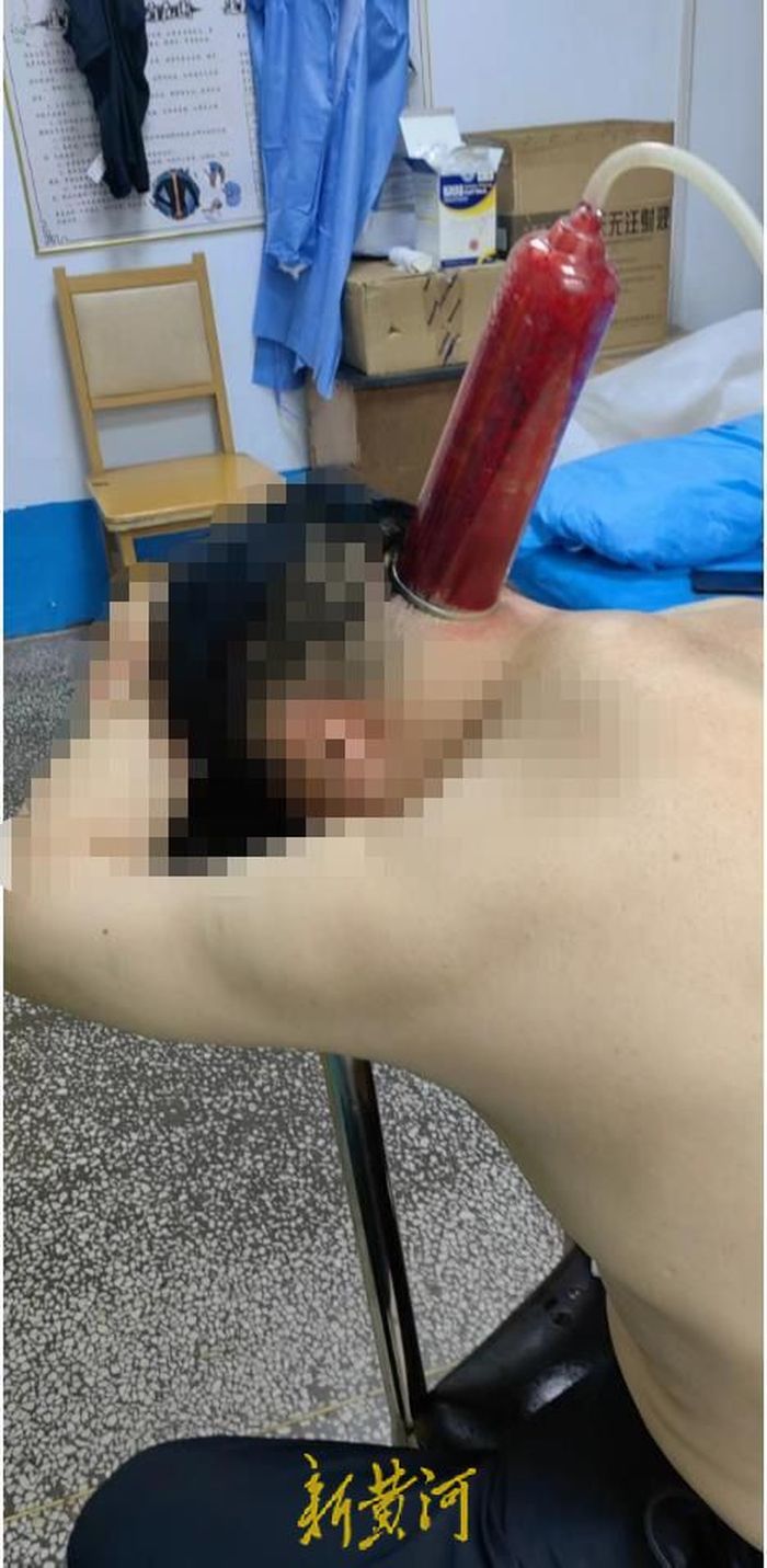 脚部瘀血10天还不消退怎么办,名医治疗双腿瘀血