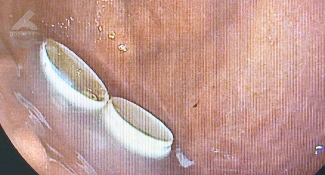 吃牛黄解毒丸后能吃辣吗,男子吃牛黄解毒丸连壳一起吞下